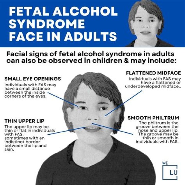 Concealed Truths: Fetal Alcohol Syndrome's Impact On Celebrities