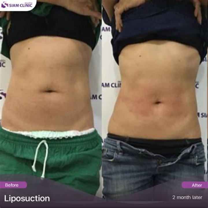 Liposuction In Sioux City: Transforming Lives Through Body Contouring