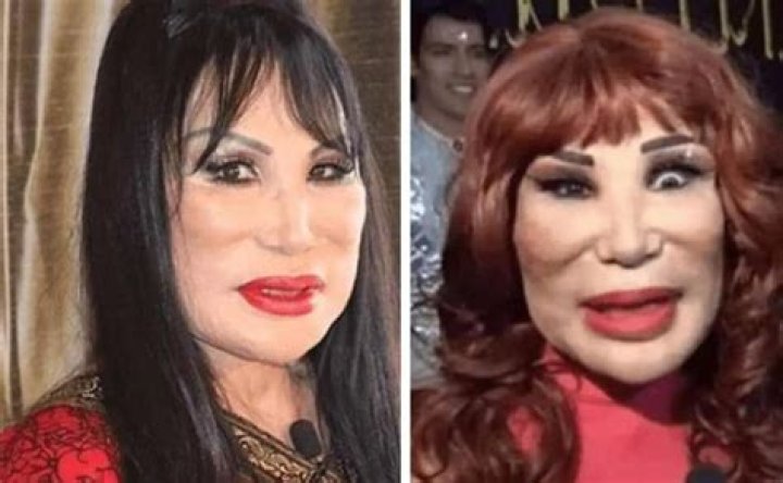 Lyn May And Her Journey With Botox: A Look At Beauty And Transformation