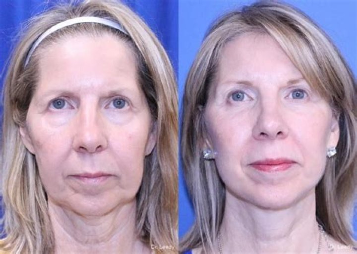 Susan Page's Facelift: Before And After Photos