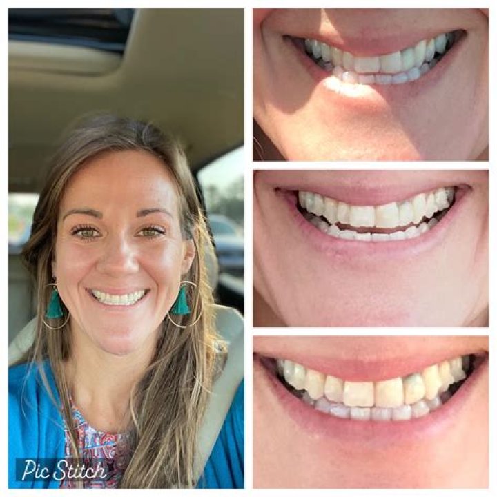 Unique Smiles: Exploring Actors With Underbites