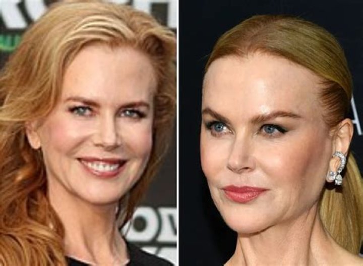 Unveiling The Truth: Did Nicole Kidman Have Plastic Surgery?